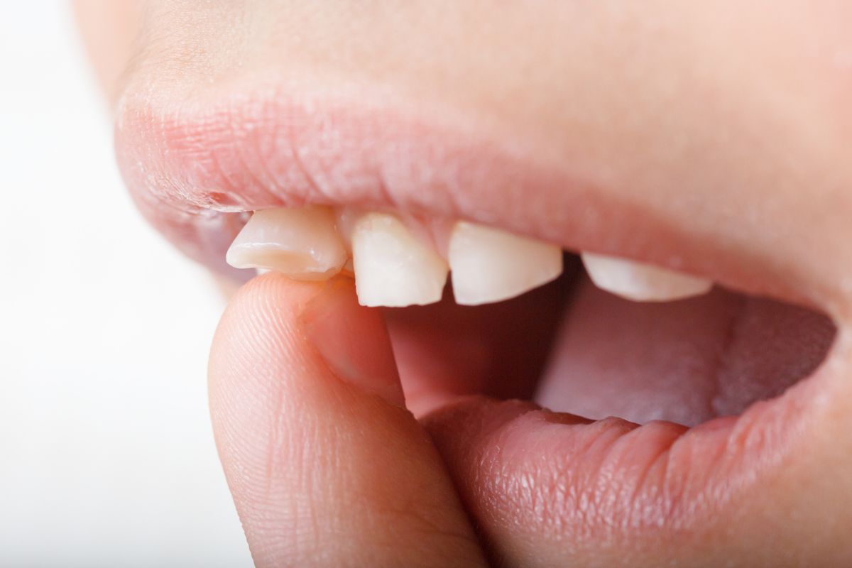 Loose Tooth Treatment